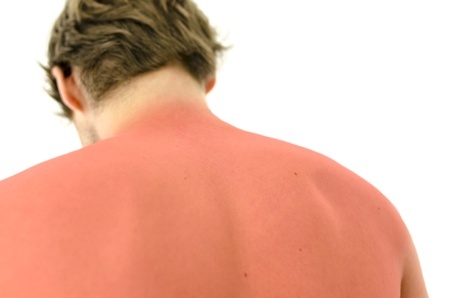Sun protection and sunburns